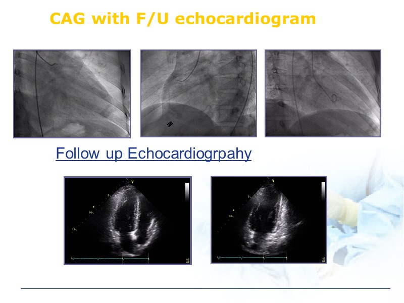 CAG with F/U echocardiogram Follow up Echocardiogrpahy